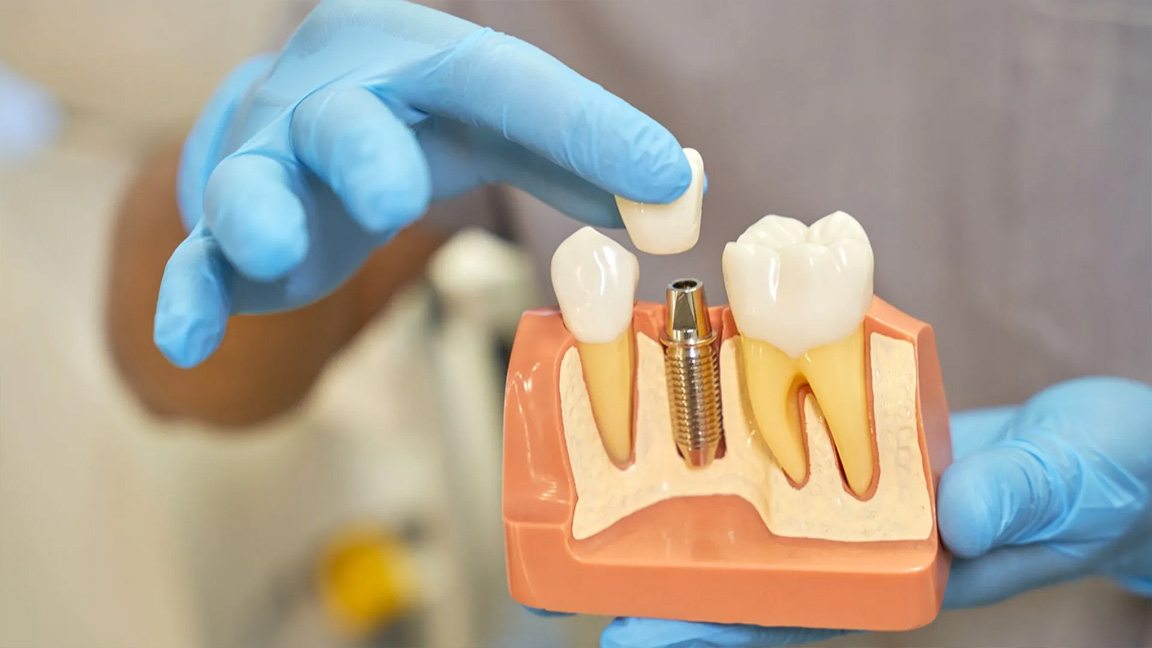 Age 20 vs 60: How Dental Implants Adapt Over Time