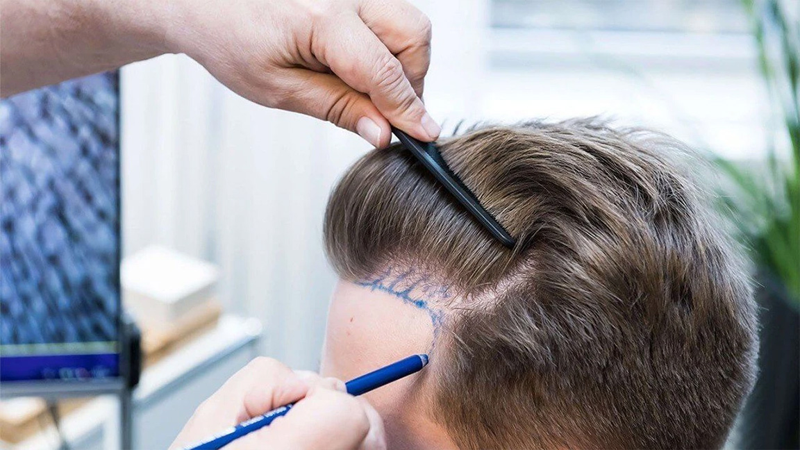 Why Some Hair Transplants Look More Natural Than Others