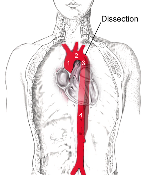Aortic Dissection