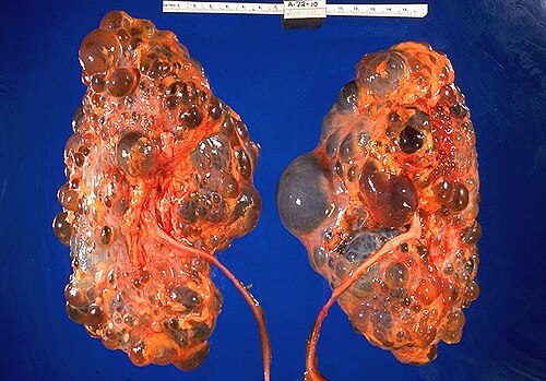 Polycystic Kidney Disease