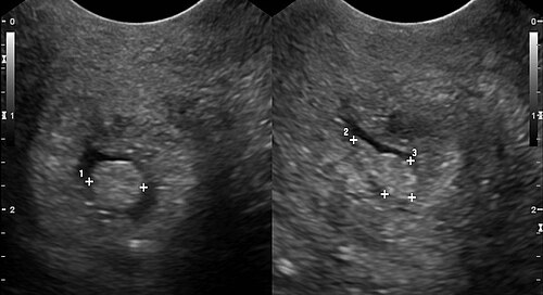 Cervical Polyp