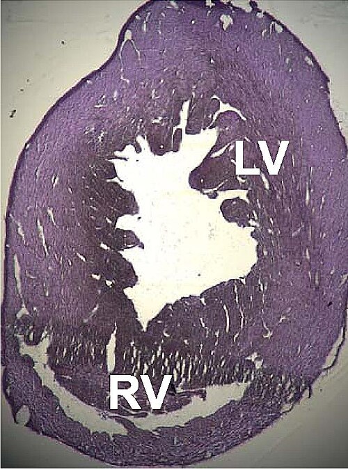 Dilated Cardiomyopathy