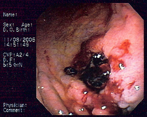 Lymphoma