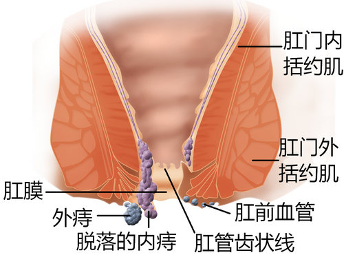 痔疮