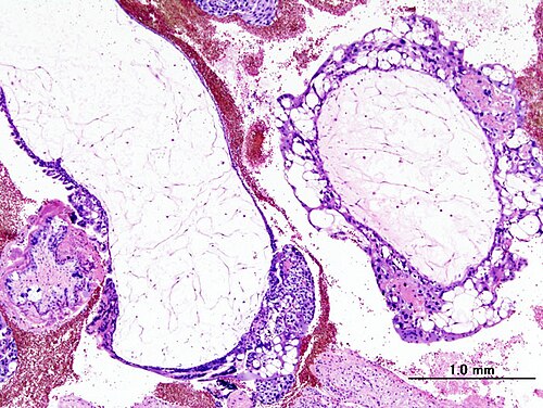 Hydatidiform Mole