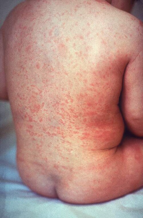 风疹